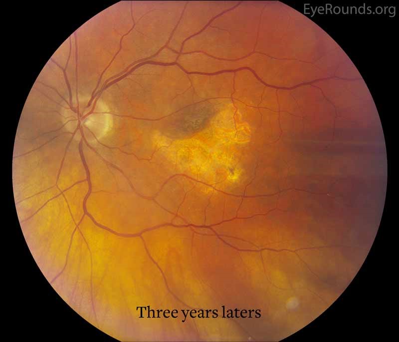 macular-degeneration-full-eye-care